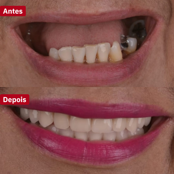 resultado-implantes-dentários-guarujá1