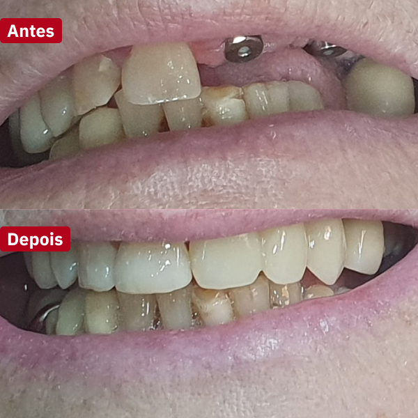 resultado-implantes-dentários-guarujá3
