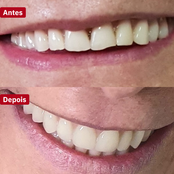 resultado-implantes-dentários-guarujá4