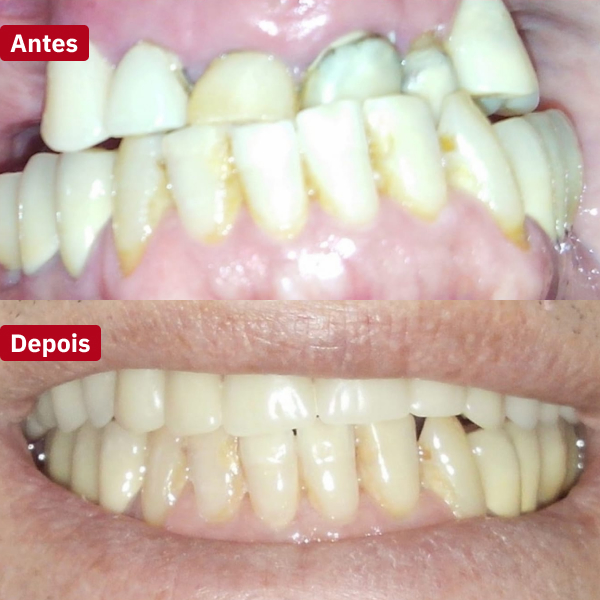resultado-implantes-dentários-guarujá5
