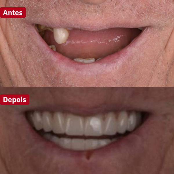 resultado-implantes-dentários-guarujá6